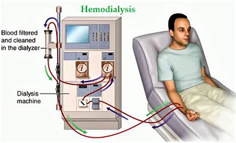 Hemodialysis 中文